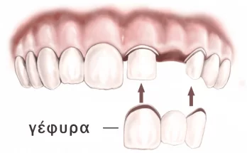 γέφυρα σε τροχισμένα δόντια