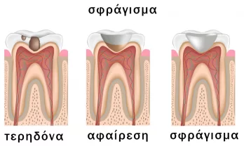 τερηδόνα και σφράγισμα